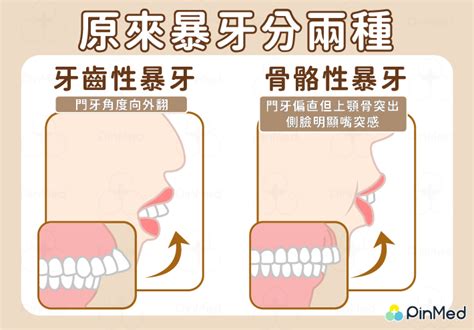 門牙暴牙面相|面相大全——牙齒